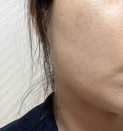 after photo: 사각턱보톡스