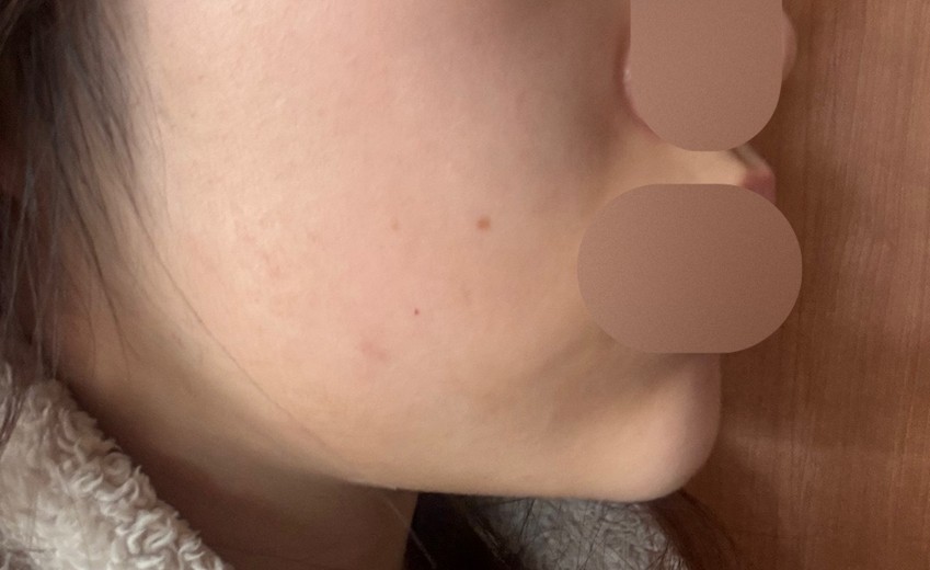 after photo: 턱끝필러