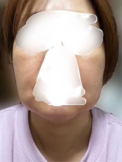 after photo: 脂肪溶解注射(顔)