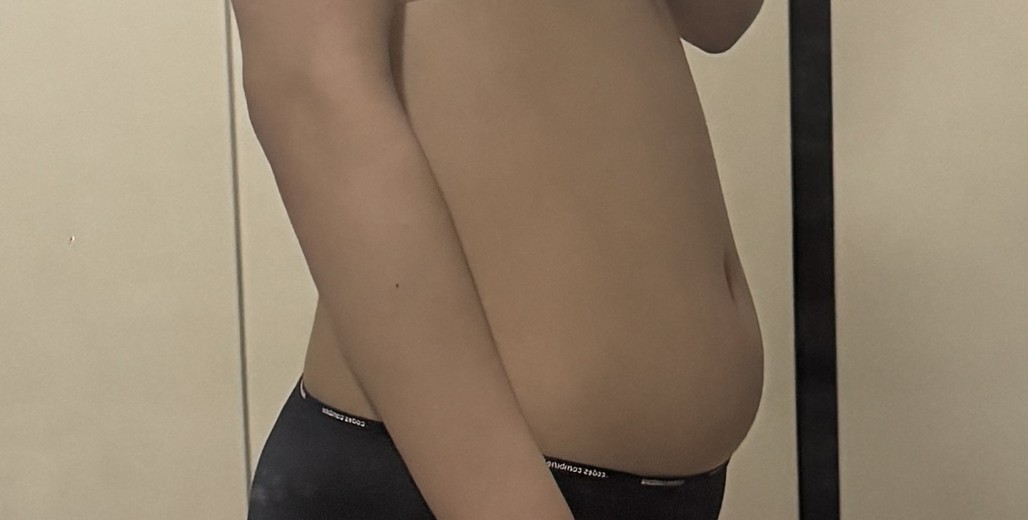 before photo: 복부지방흡입