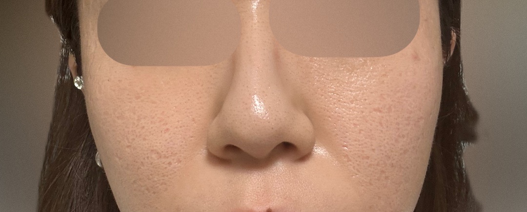 一代エレクトロポレーションハイドラフェイシャル