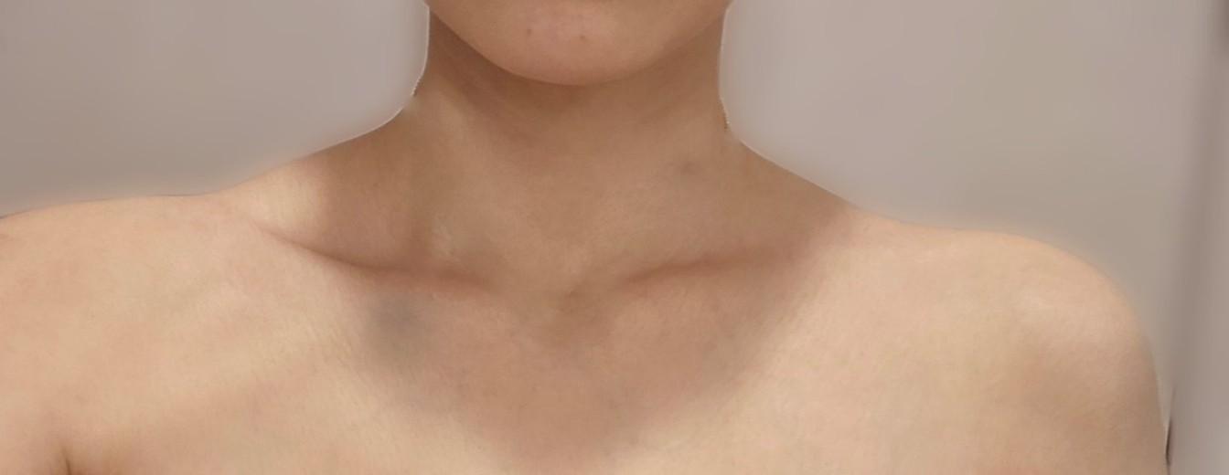 after photo: 肩ボトックス(僧帽筋)