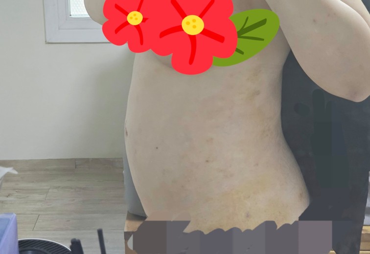 after photo: 러브핸들지방흡입, 복부지방흡입