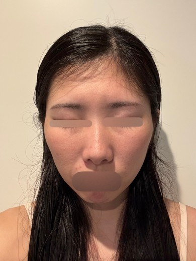 after photo: ヴェルベットスキン