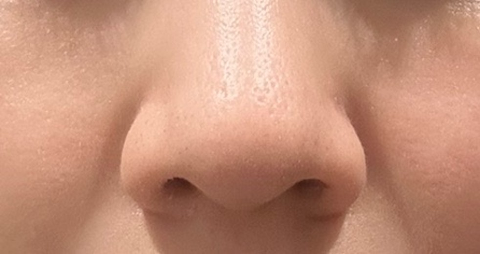 after photo: 脂肪溶解注射(顔)