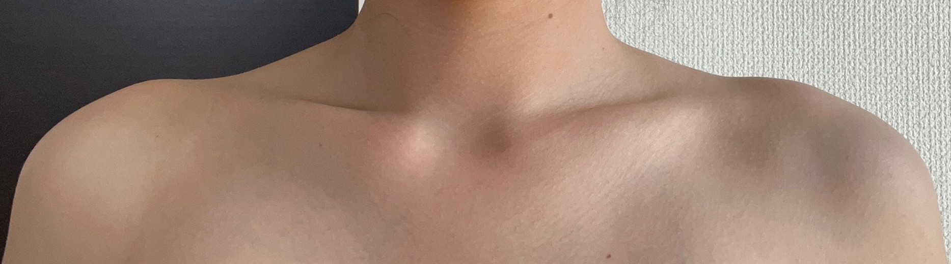 after photo: 脇ボトックス, エラボトックス, 肩ボトックス(僧帽筋)
