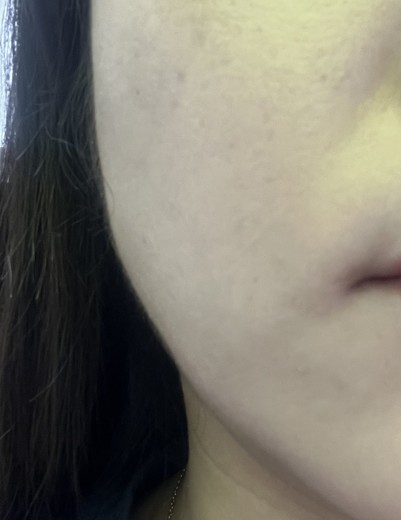 before photo: 사각턱보톡스