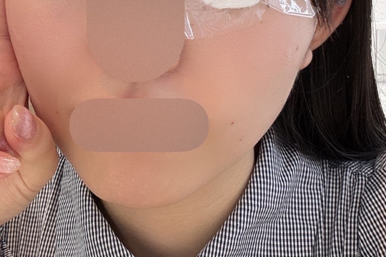 after photo: ほうれい線ヒアルロン酸