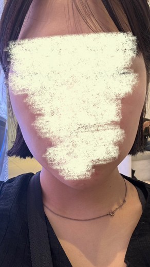before photo: インモード
