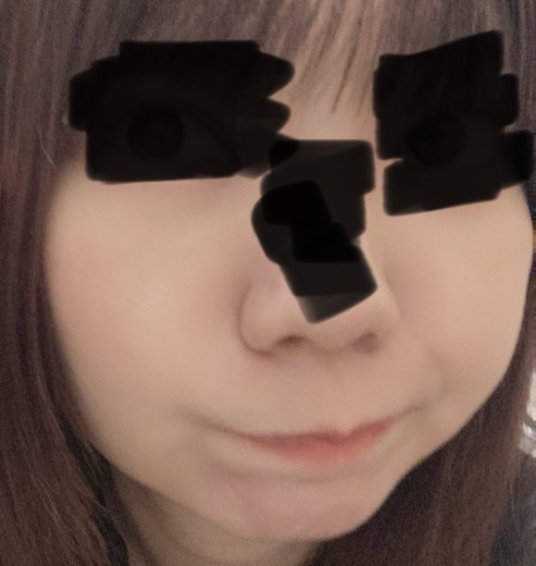 before photo: 糸リフト