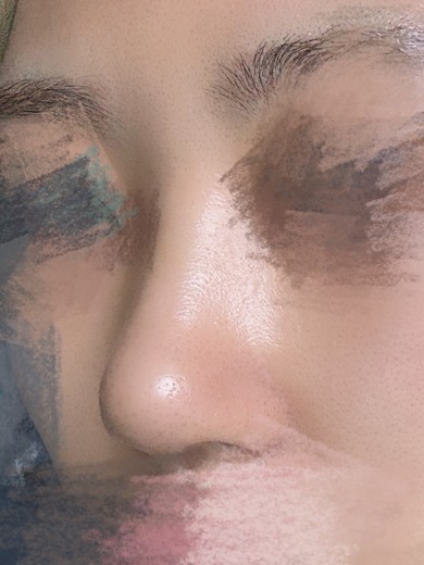 after photo: 콧대(보형물), 코끝(자가연골), 복코교정(수술)