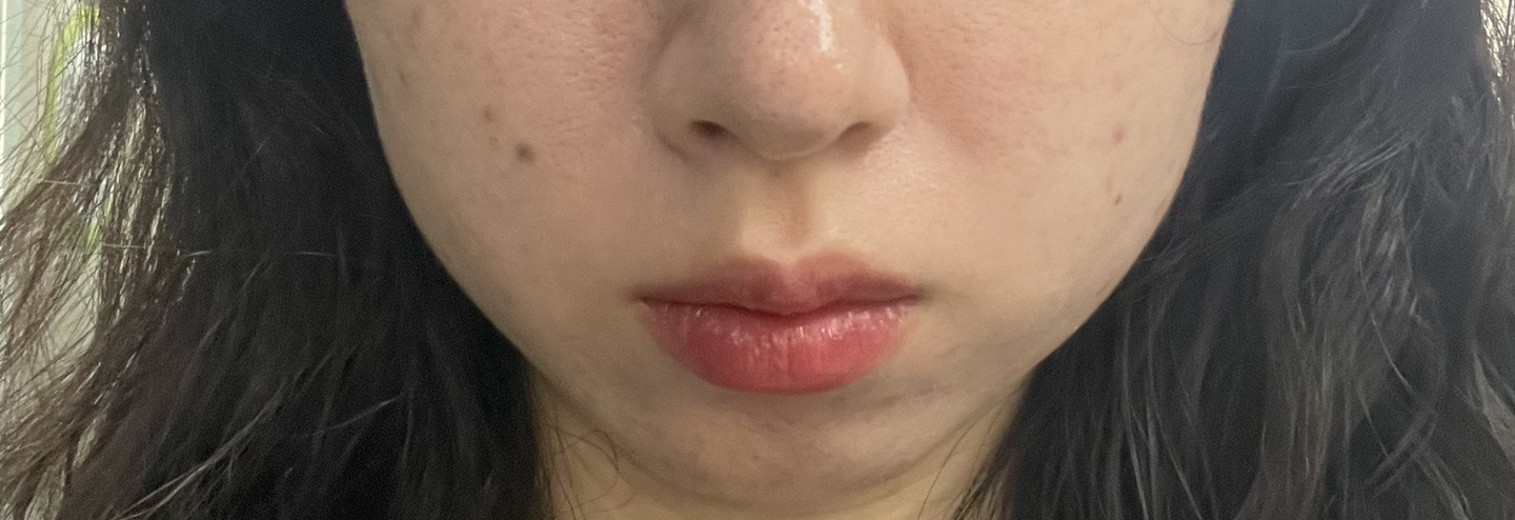 after photo: 사각턱보톡스