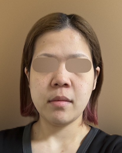 before photo: フラクショナルレーザー, レーザートーニング, ほくろ除去(レーザー)