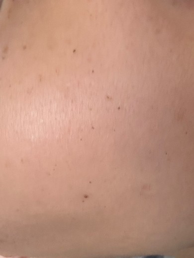 after photo: IPL(光/フォト治療), 診断・検査