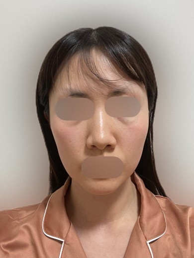 before photo: ルメッカ