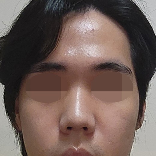 before photo: 코끝(자가연골)