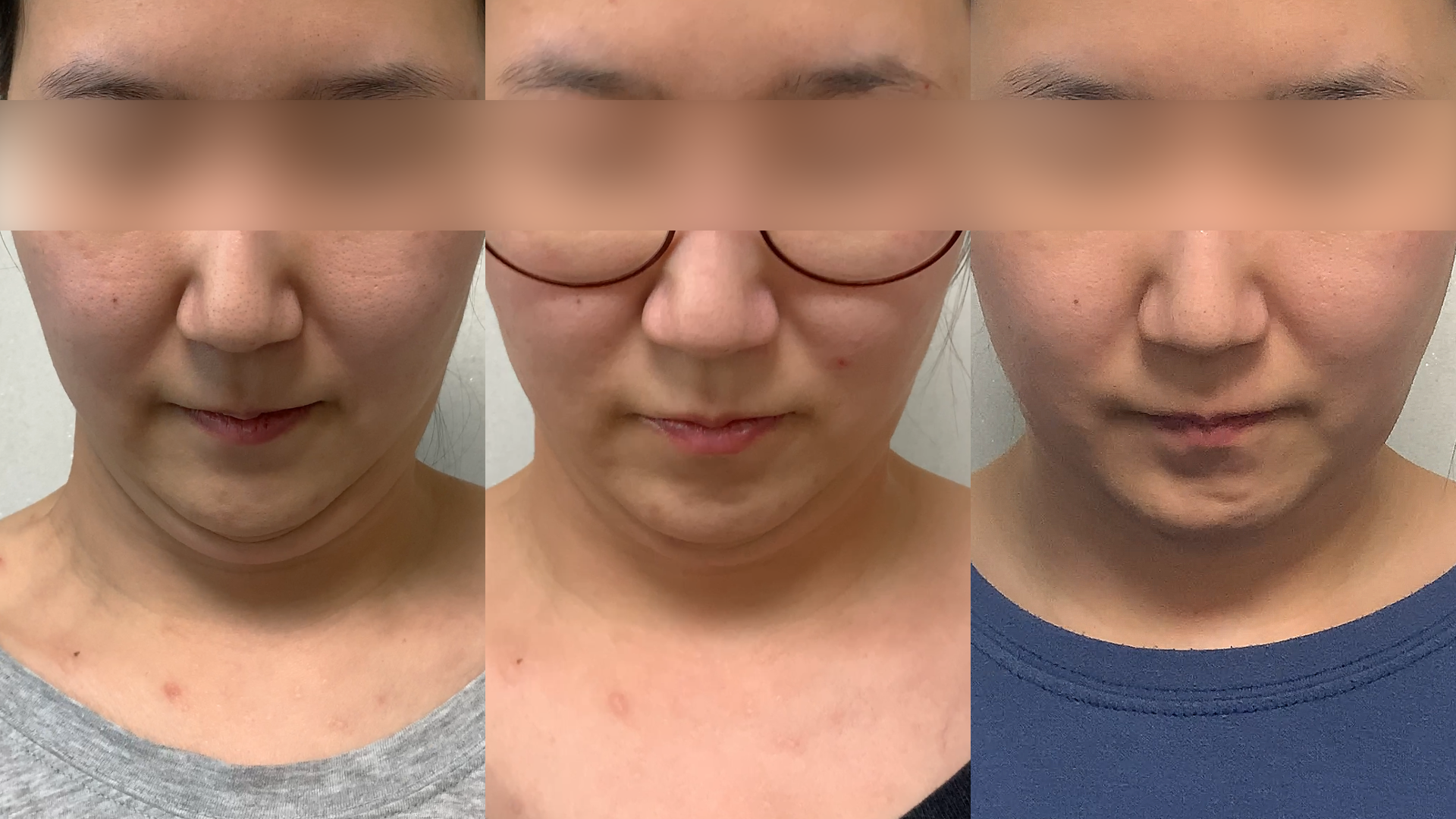 脂肪溶解注射の施術・口コミ・クリニック情報(2025) | カンナムオンニ